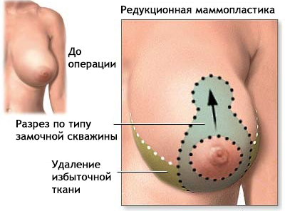 редукционная маммопластика